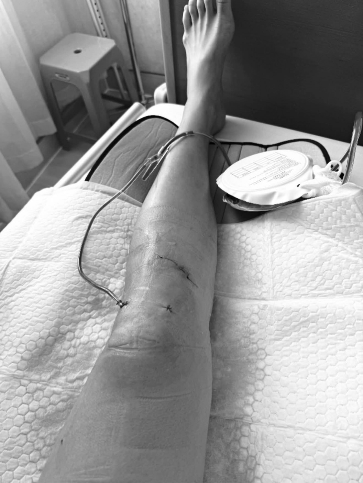 Chấn thương nghiêm trọng của Mình Tú khiến fan lo lắng